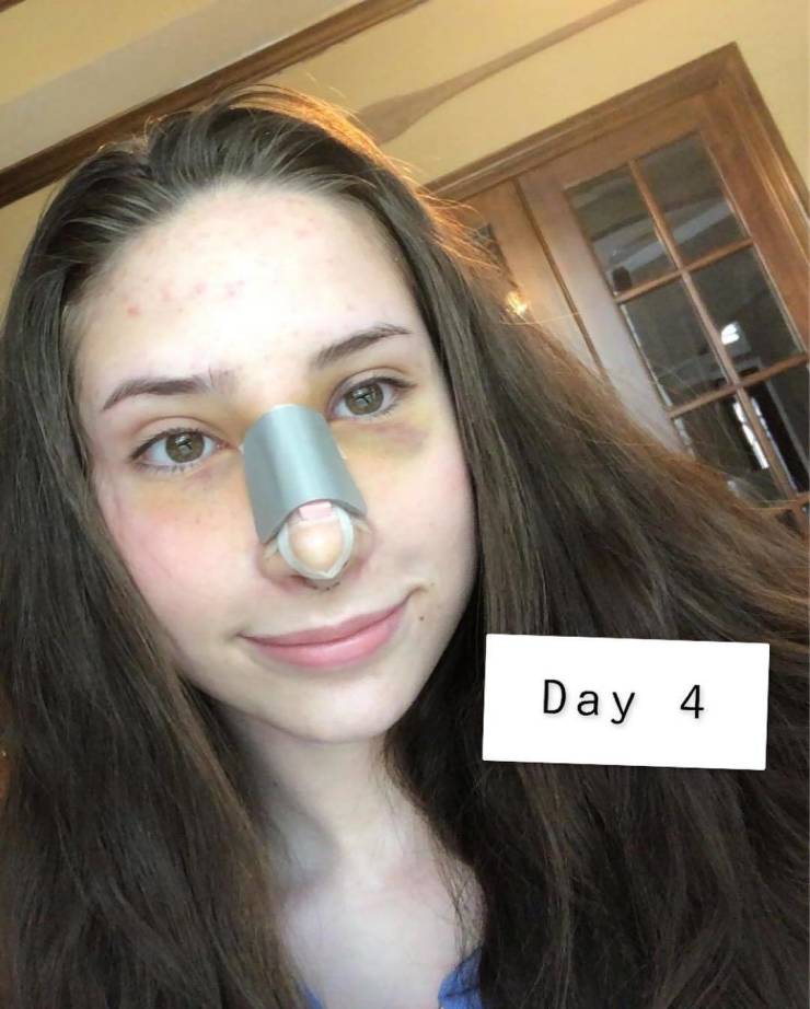 Girl Spends $10,000 On Rhinoplasty After Being Called A “Toucan” By A School Bully