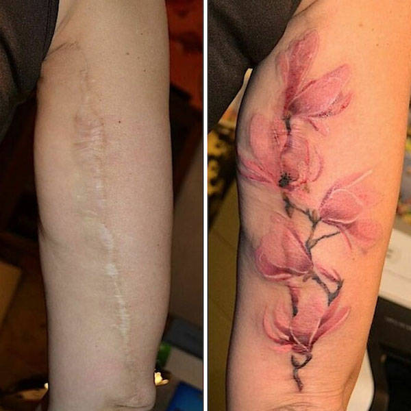 Tattoo Artists Covering Scars And Birthmarks
