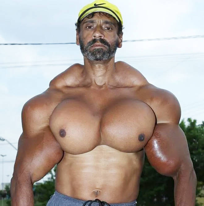 Synthol Does NOT Look Good, Guys…
