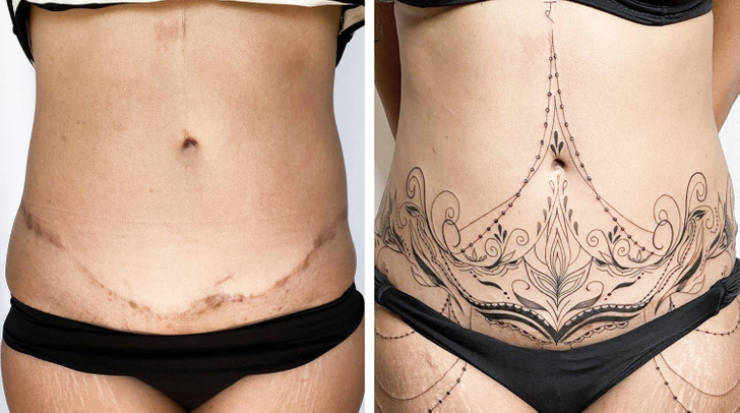 Artist Saves People’s Scars By Tattooing Over Them