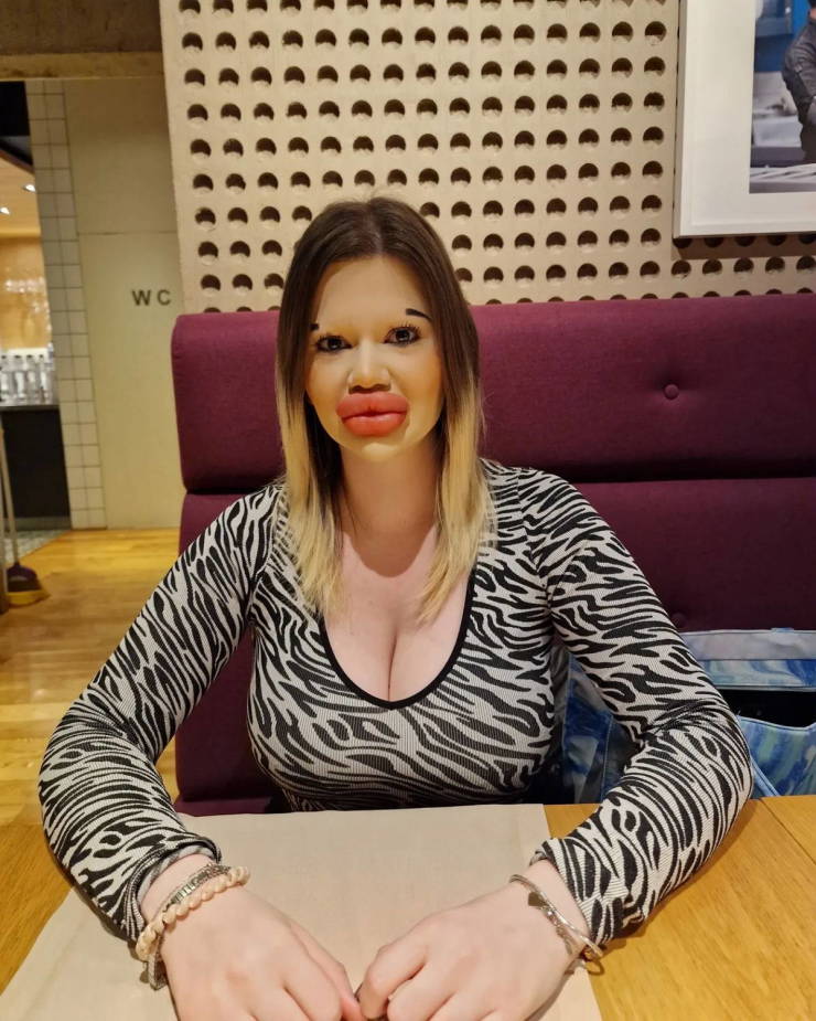 The Owner Of The Largest Lips In The World Wants To Increase Them Even More
