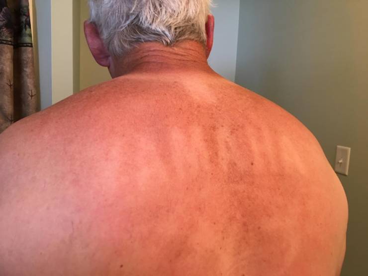 Sunburn Disasters That