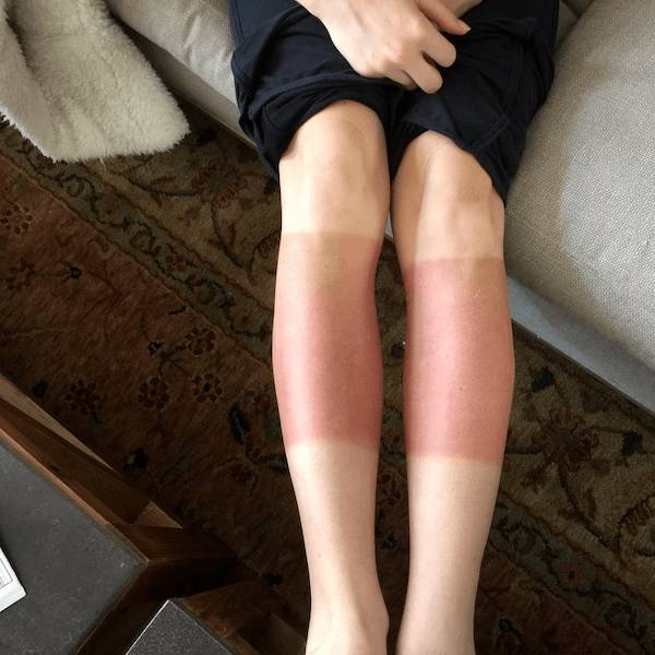 Sunburn Disasters That