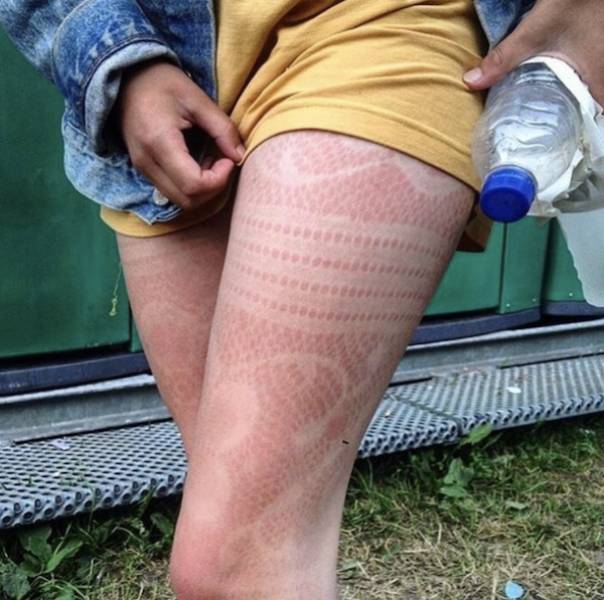 Sunburn Disasters That