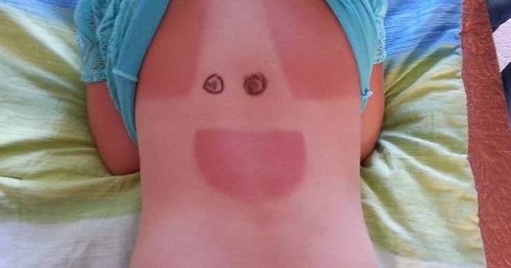 Sunburn Disasters That