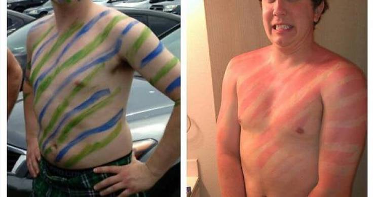 Sunburn Disasters That