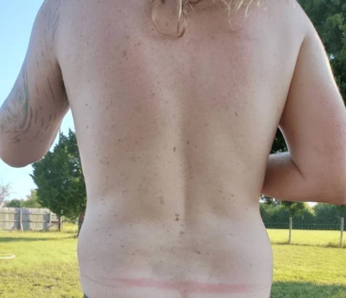 Sunburn Disasters That