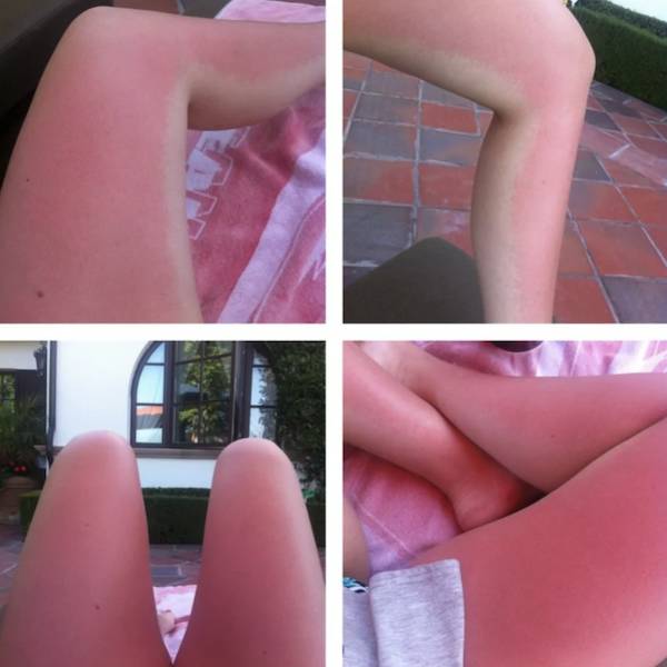 Sunburn Disasters That