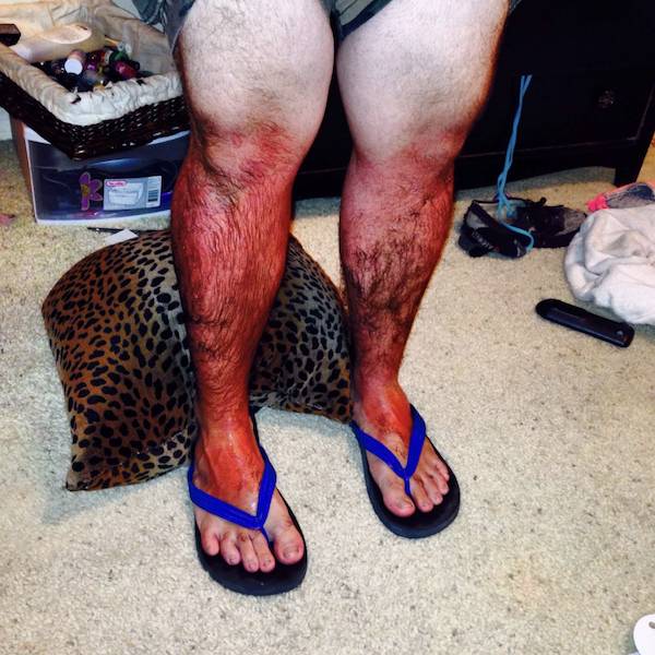 Sunburn Disasters That
