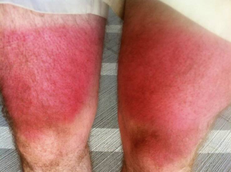 Sunburn Disasters That