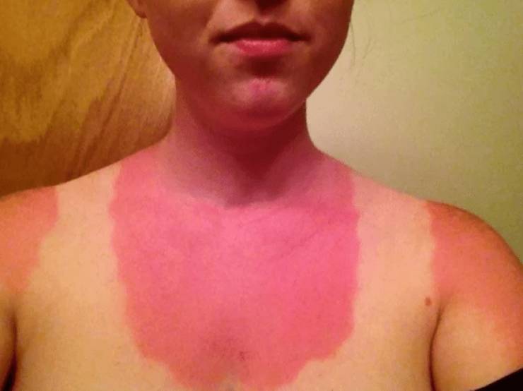 Sunburn Disasters That