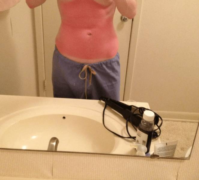 Sunburn Disasters That