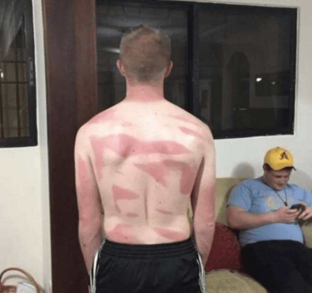 Sunburn Disasters That