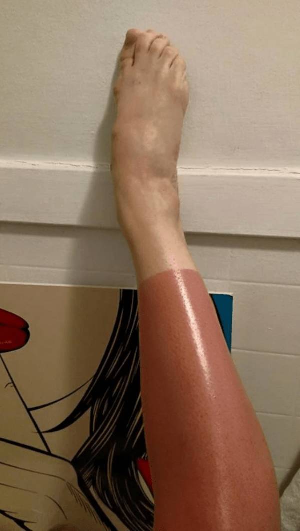 Sunburn Disasters That