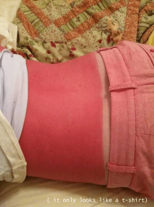 Sunburn Disasters That