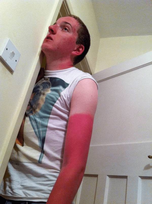 Sunburn Disasters That