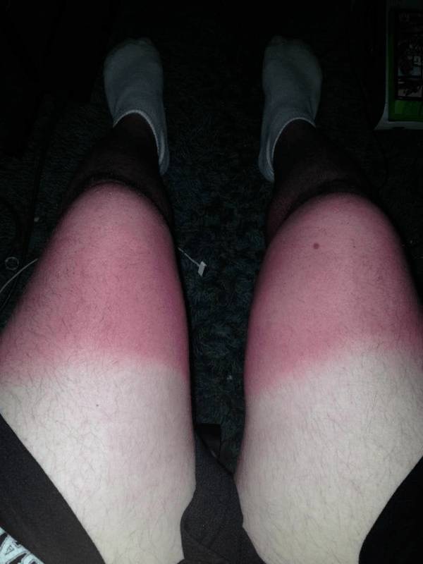 Sunburn Disasters That