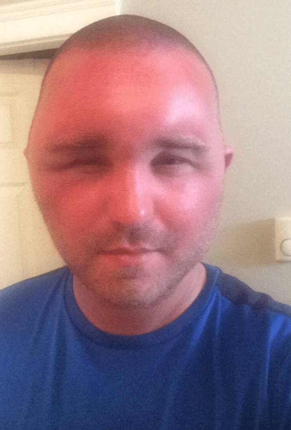 Sunburn Disasters That