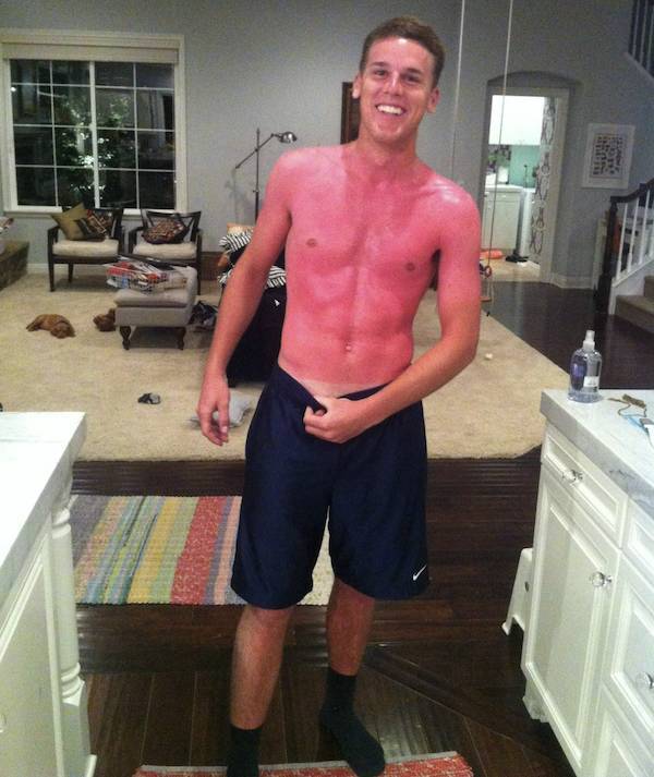 Sunburn Disasters That