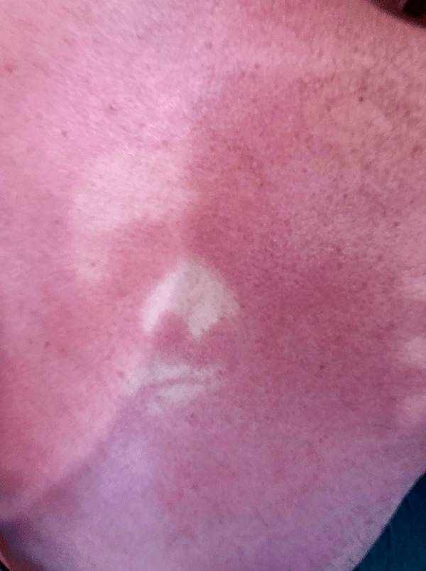 Sunburn Disasters That