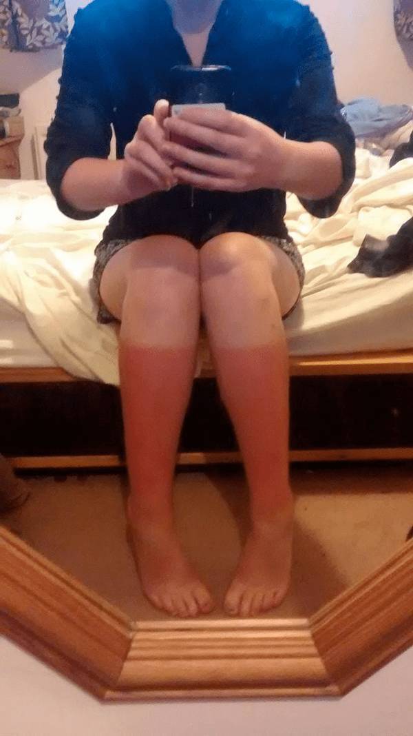 Sunburn Disasters That