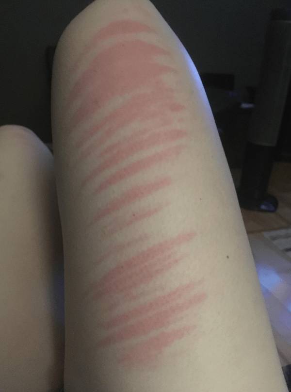Sunburn Disasters That