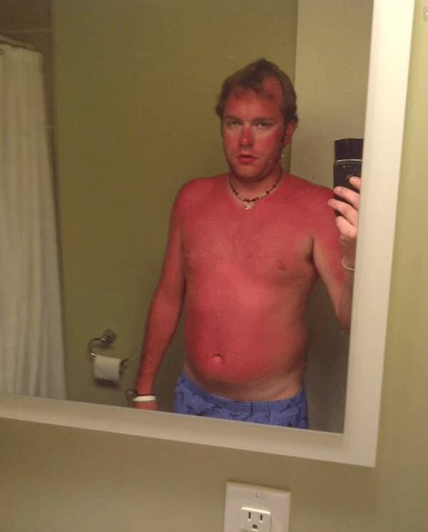 Sunburn Disasters That