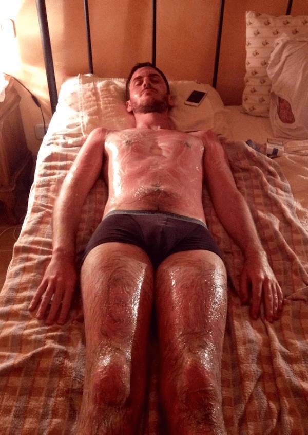 Sunburn Disasters That