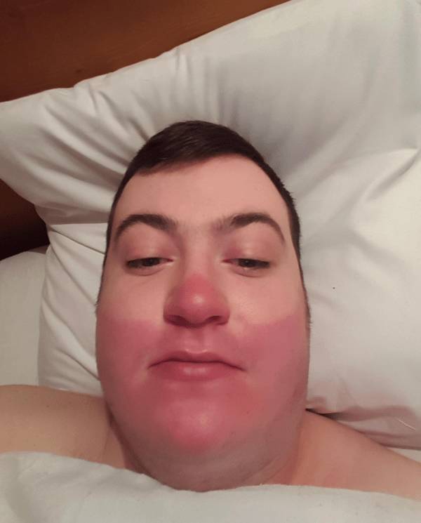 Sunburn Disasters That