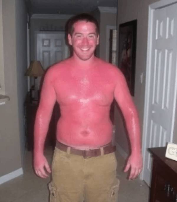 Sunburn Disasters That