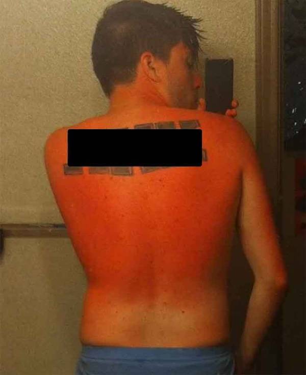 Sunburn Disasters That
