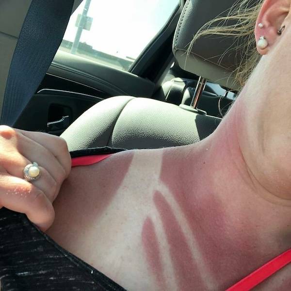 How’s Your Summer Sunburn?