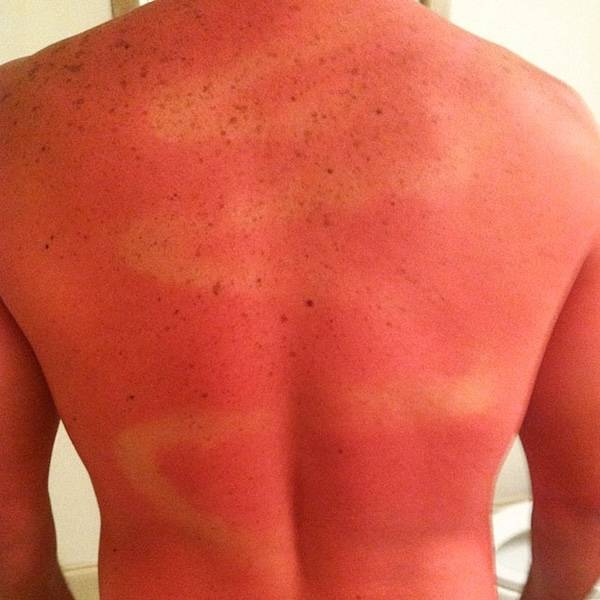 How’s Your Summer Sunburn?