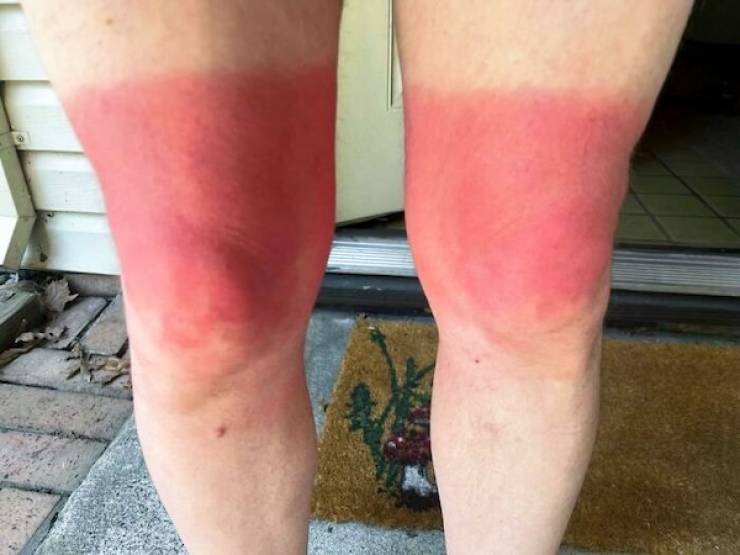 How’s Your Summer Sunburn?