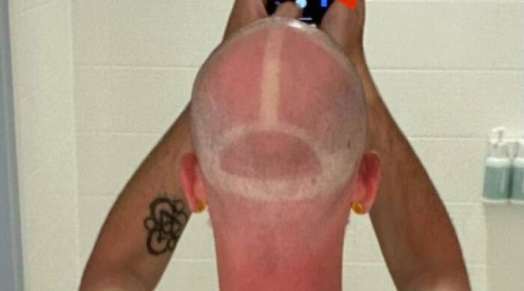 How’s Your Summer Sunburn?