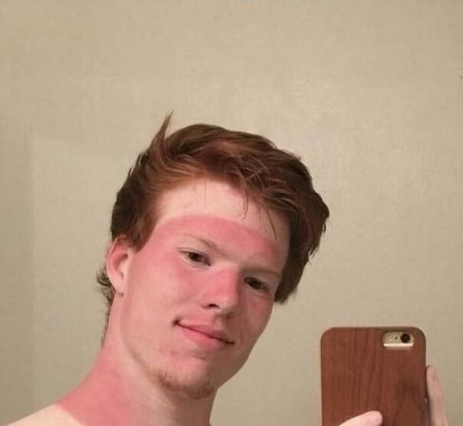 How’s Your Summer Sunburn?