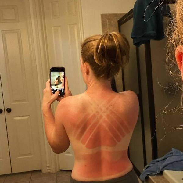 How’s Your Summer Sunburn?