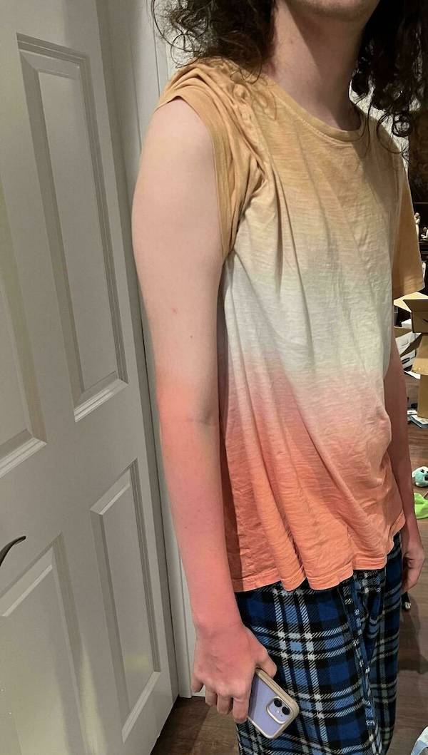 How’s Your Summer Sunburn?