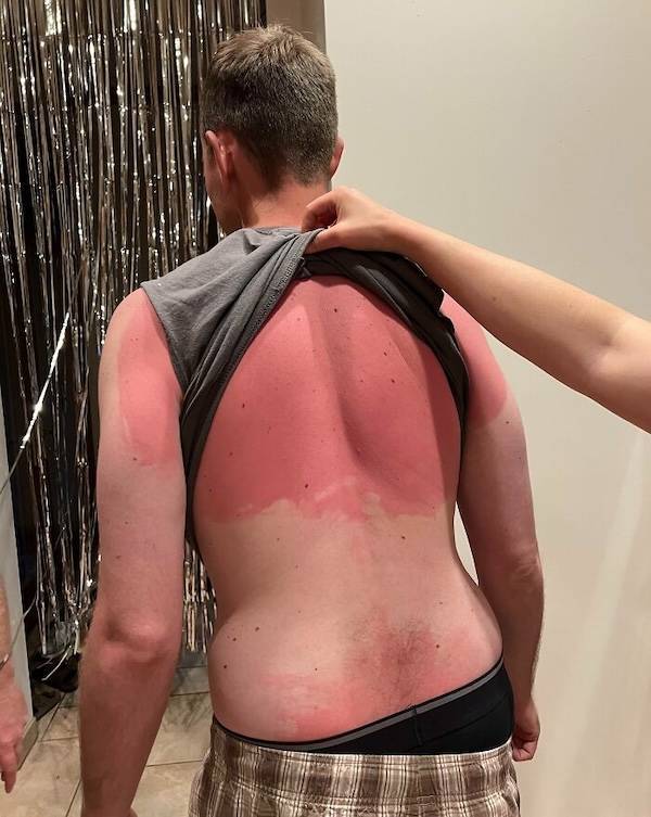 How’s Your Summer Sunburn?