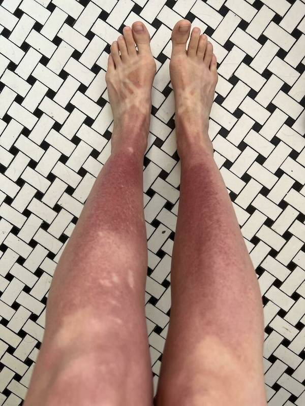 How’s Your Summer Sunburn?