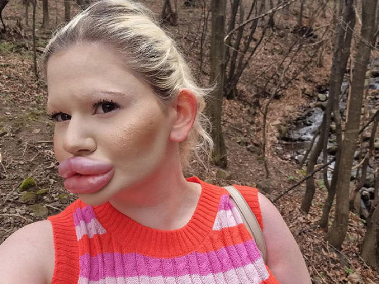Andrea Ivanova: The Influencer Known For Her Extreme Lip Filler Addiction