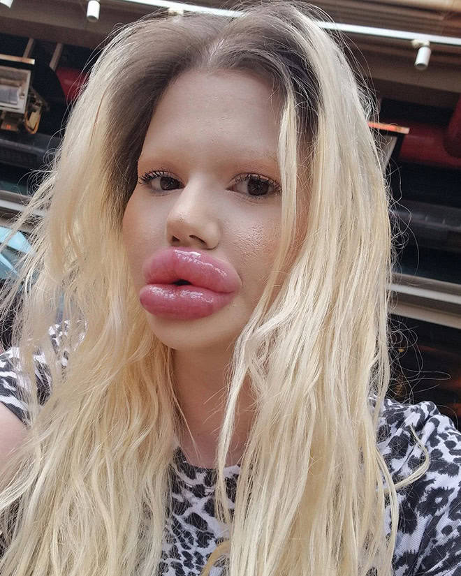 Andrea Ivanova: The Influencer Known For Her Extreme Lip Filler Addiction