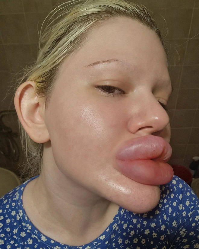 Andrea Ivanova: The Influencer Known For Her Extreme Lip Filler Addiction