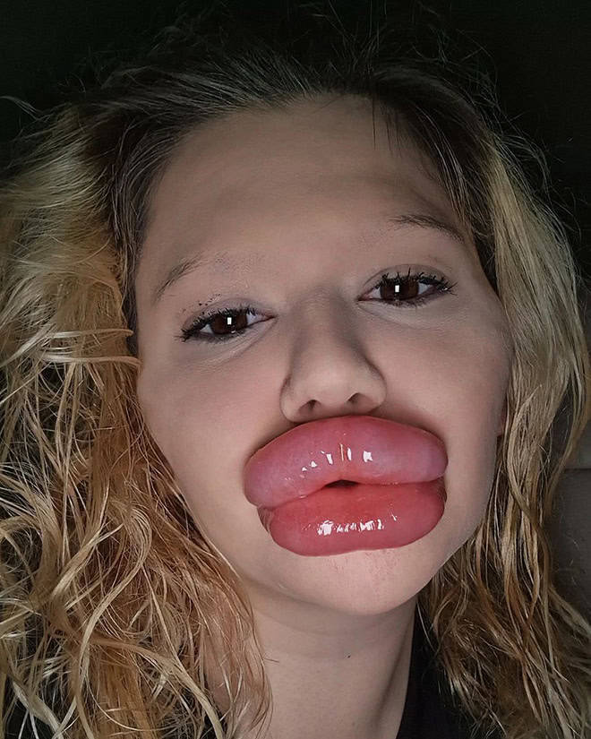 Andrea Ivanova: The Influencer Known For Her Extreme Lip Filler Addiction