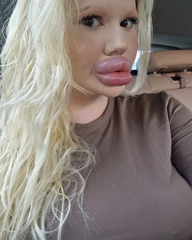 Andrea Ivanova: The Influencer Known For Her Extreme Lip Filler Addiction