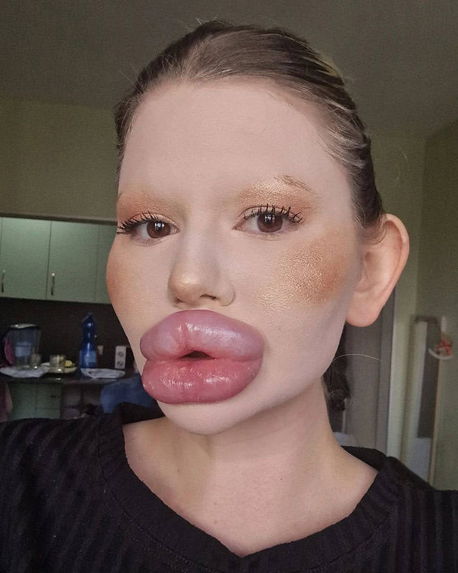 Andrea Ivanova: The Influencer Known For Her Extreme Lip Filler Addiction
