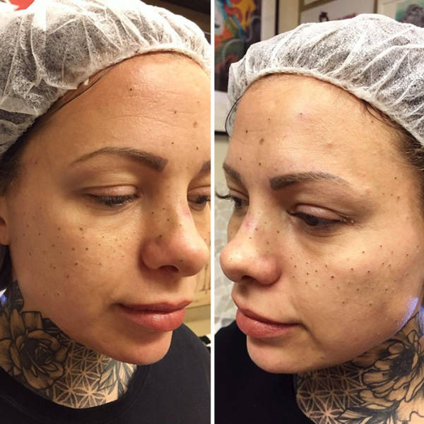 Some Try To Remove Their Natural Freckles – Others Tattoo Artificial Ones
