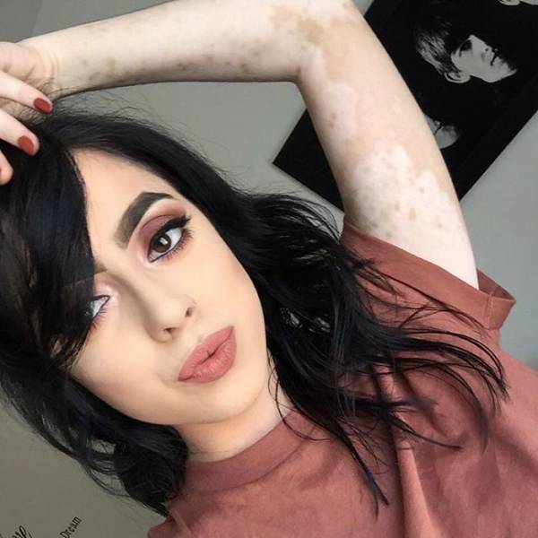 This Girl Turned Her Skin Disease Into A Piece Of Art And This Is Truly Beautiful!