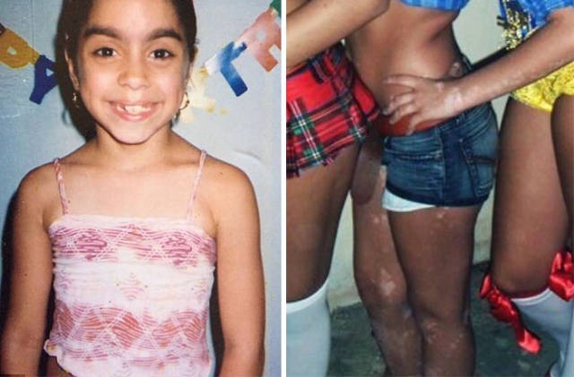 This Girl Turned Her Skin Disease Into A Piece Of Art And This Is Truly Beautiful!