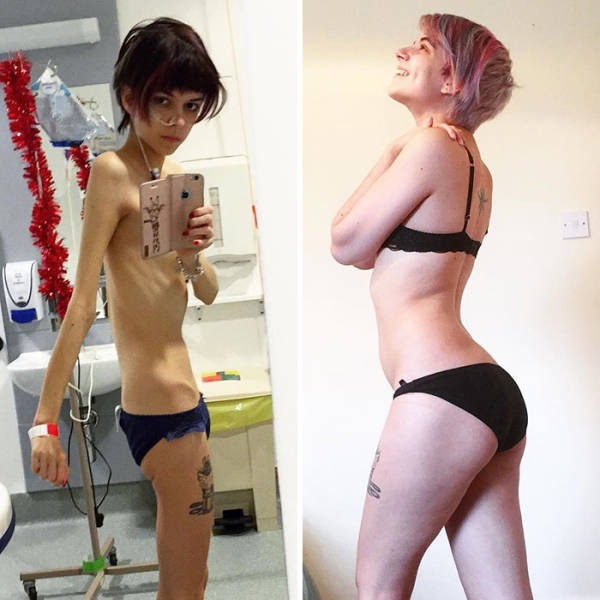 Anorexia Is Not The Final Verdict!